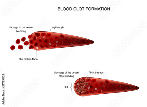 formation of a blood clot photo