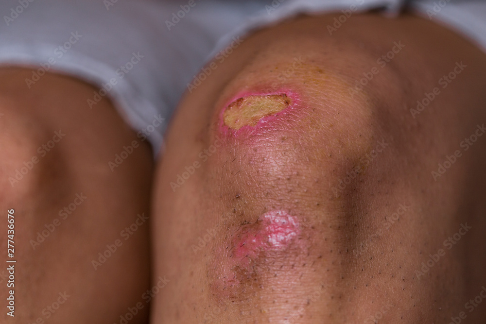 Fototapeta premium Women injury - painful knee wound accident - Bruised wound injury on woman knee - Medical and health conditions