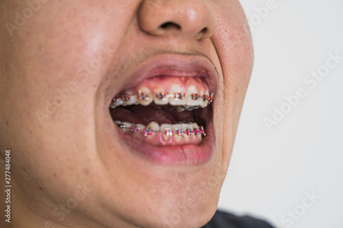 Asian women's teeth aged 25-30 years, not scale. Yellow teeth,Women wearing braces.