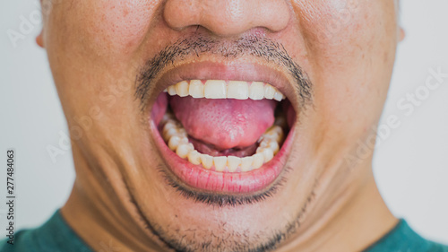 Asian men's teeth aged 25-30 years, not scaled. Yellow teeth