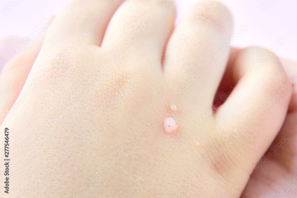 The doctor holds a small hand of a child affected with warts with selective focus on blurred pink background. Papillomavirus in a child's hand and fingers. Pediatric dermatology. Skin diseases The doctor holds a small hand of a child affected with warts with selective focus on blurred pink background. Papillomavirus in a child's hand and fingers. Pediatric dermatology. Skin diseases