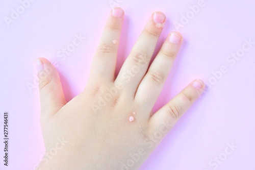 White baby hands affected by the wart with selective focus on blurred pink background. Papillomavirus on kids skin. Warts disease in a child's hand and fingers. Pediatric dermatology. Skin diseases