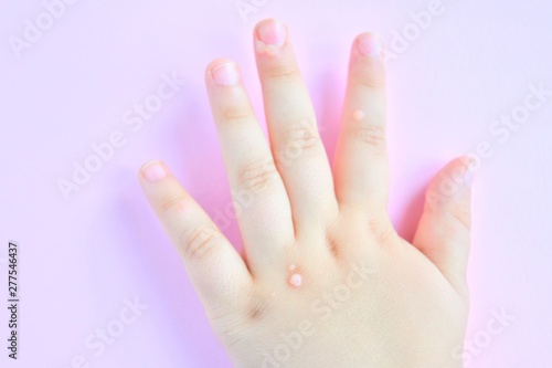 White baby hands affected by the wart with selective focus on blurred pink background. Papillomavirus on kids skin. Warts disease in a child s hand and fingers. Pediatric dermatology. Skin diseases