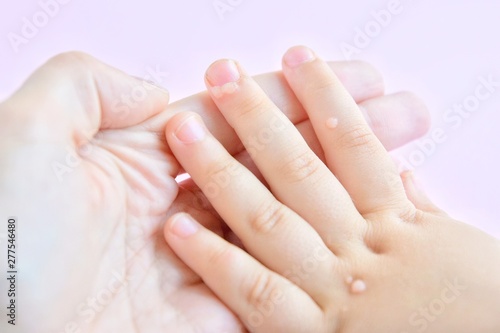 The doctor holds a small hand of a child affected with warts with selective focus on blurred pink background. Papillomavirus in a child's hand and fingers. Pediatric dermatology. Skin diseases