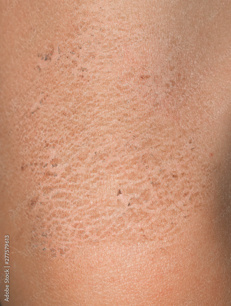 Affected skin of a child's corrosion dry crust flakes for medicine Affected skin of a child's corrosion dry crust flakes for medicine