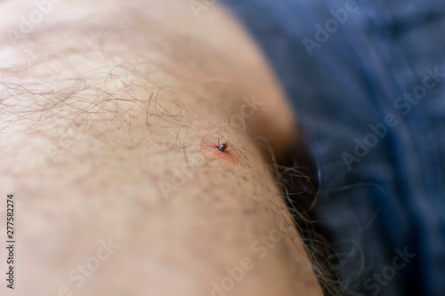 The tick bites the man's leg. sucked deep under the skin.