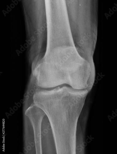 film x-ray knee of osteoarthritis knee patient