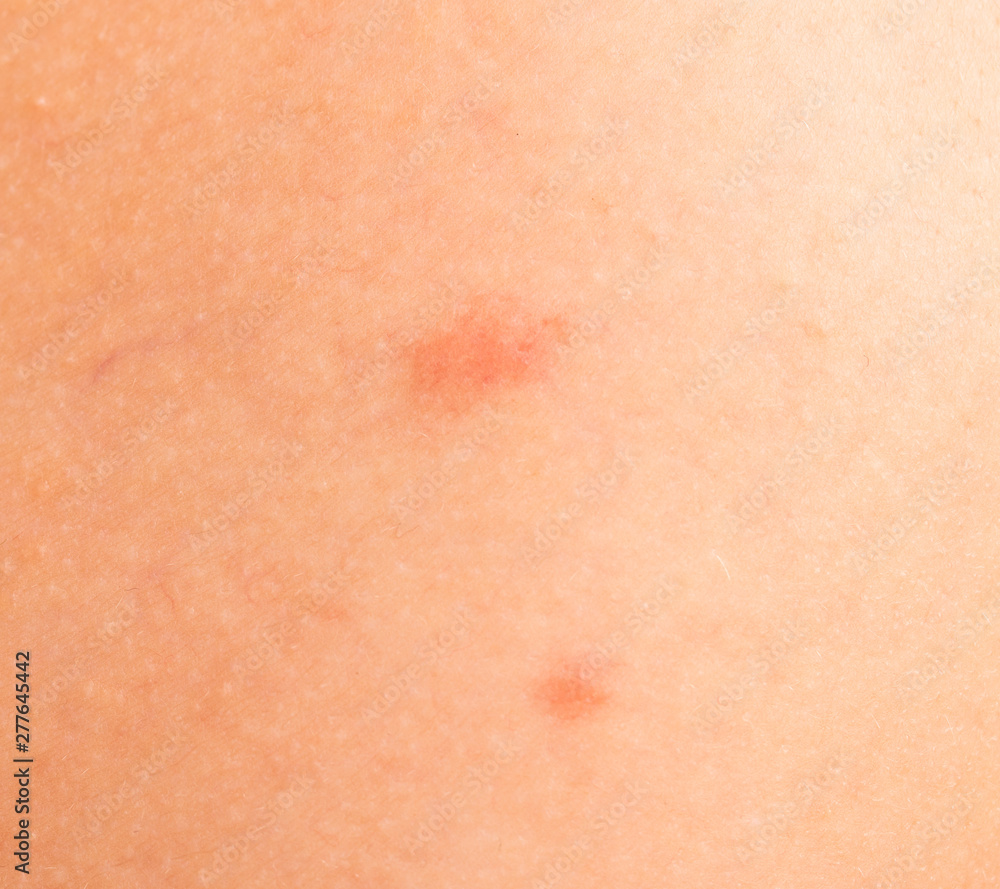 scratches on the skin of a child scratches on the skin of a child
