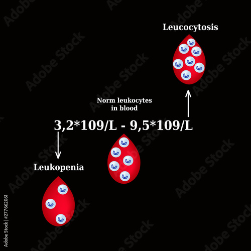White blood cell count. Leukopenia. Leukocytosis. Infographics. Vector illustration