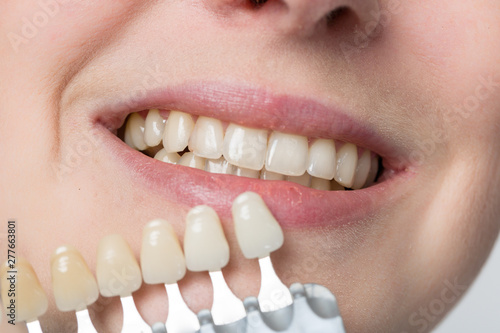using shade guide at woman's mouth to check veneer of teeth for bleaching