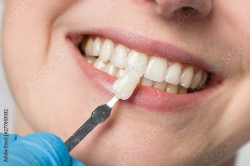 dentist using shade guide at woman's mouth to check veneer of teeth for bleaching