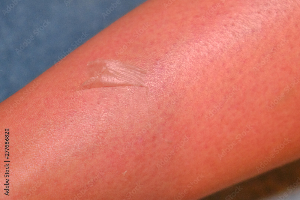Skin comes off with the women's legs after sunburn Problems of long exposure to the sun. Burnt skin of a woman after a vacation on the beach. Skin comes off with the women's legs after sunburn Problems of long exposure to the sun. Burnt skin of a woman after a vacation on the beach.