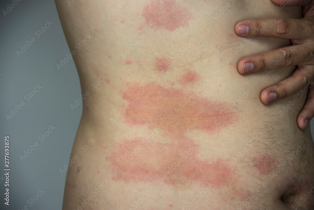 Fototapeta premium Man getting red skin rash at his body part - people with skin allergy problem concept