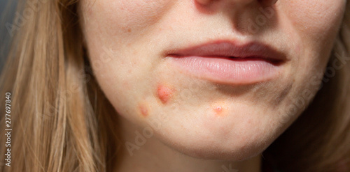Woman's oily skin with acne problems. Scars and wounds on the face. Health care photo.