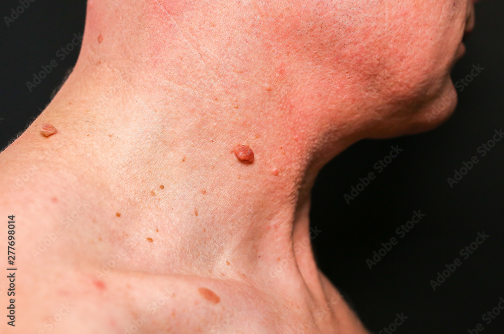 Big birthmark on the man's skin. Medical health photo. Papillomas on the neck. Big birthmark on the man's skin. Medical health photo. Papillomas on the neck.