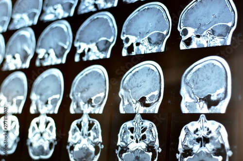 Magnetic resonance image scan of a man brain with a colloid cyst. MRI film of a human skull and brain tumor. Neurology background. Medicine, science.