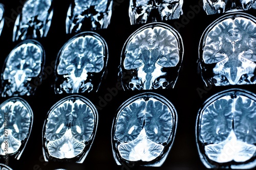 Magnetic resonance image scan of a man brain with a colloid cyst. MRI film of a human skull and brain tumor. Neurology background. Medicine, science.