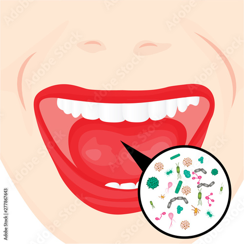 Bacterial overgrowth in a mouth.