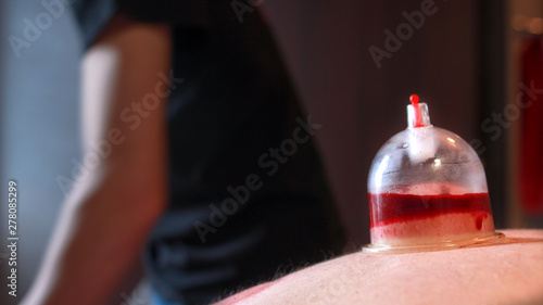 Hijama - the treatment of bloodletting. Attached vacuum cup. Blood fills in the cup.