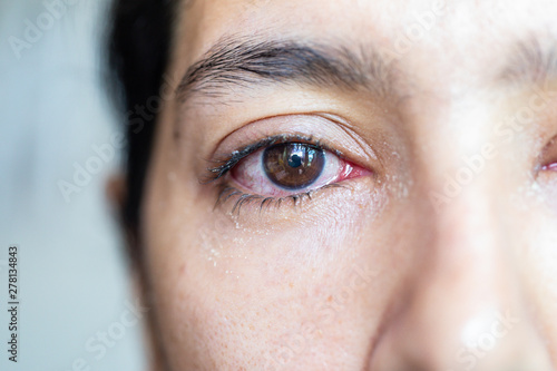 фотографія Closeup  of irritated red eye of a patient with human conjunctivitis or infected