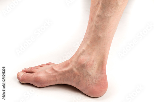 naked leg of a man with varicose veins on a white background