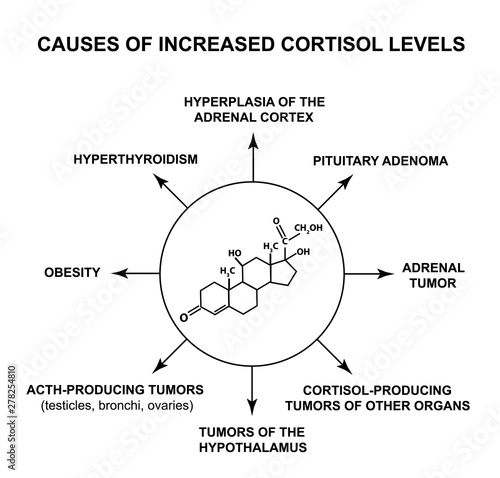 Causes of increased cortisol levels. The stress hormone cortisol is a chemical molecular formula. Infographics. Vector illustration on isolated background.