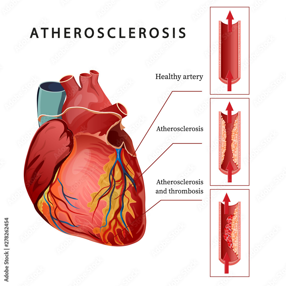 Atherosclerosis Illustration Of The Human Heart Healthy Artery