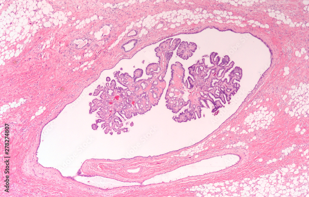 Breast Biopsy Microscopic image (photomicrograph) of an intraductal