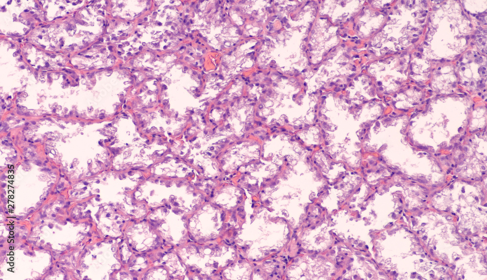 Breast biopsy histology from a pregnant woman showing lactating adenoma