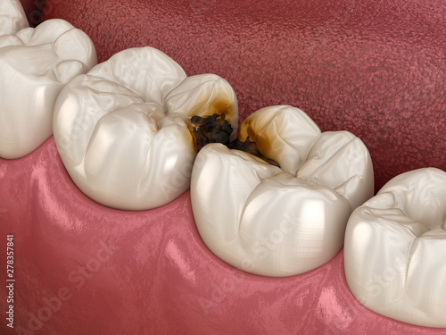 Obraz na płótnie Molar teeth damaged by caries
