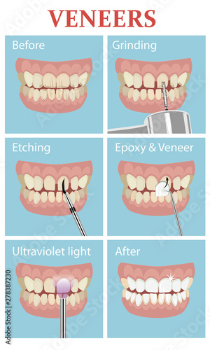 Veneers medical poster