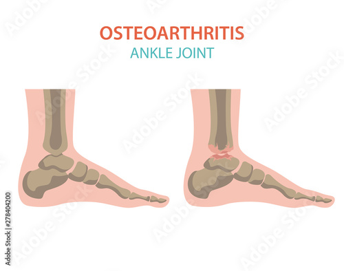 Arthritis, osteoarthritis medical infographic design. Joint replacement, implantant.