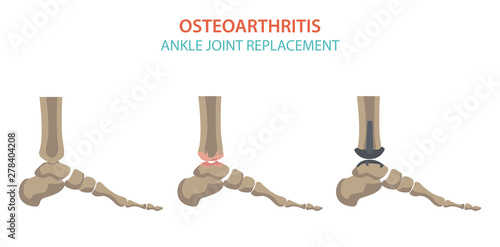 Arthritis, osteoarthritis medical infographic design. Joint replacement, implantant.