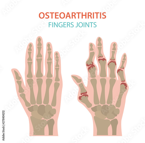 Arthritis, osteoarthritis medical infographic design. Joint replacement, implantant.