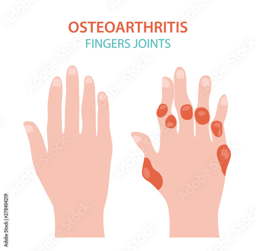 Arthritis, osteoarthritis medical infographic design. Joint replacement, implantant.