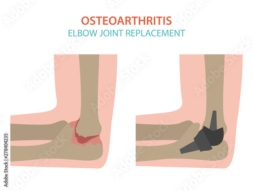 Arthritis, osteoarthritis medical infographic design. Joint replacement, implantant.