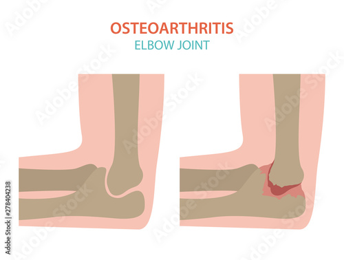 Arthritis, osteoarthritis medical infographic design. Joint replacement, implantant.