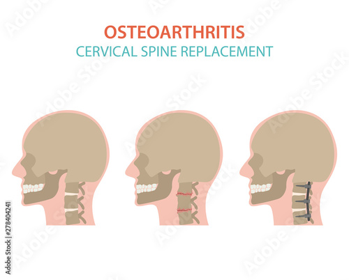 Arthritis, osteoarthritis medical infographic design. Joint replacement, implantant.
