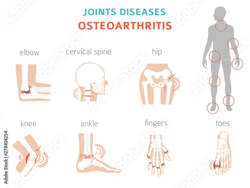 Arthritis, osteoarthritis medical infographic design. Joint replacement, implantant.