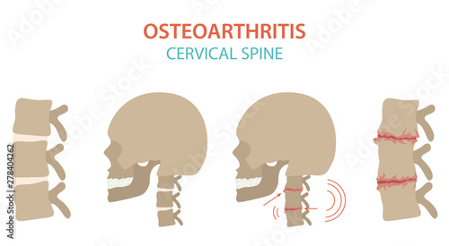 Arthritis, osteoarthritis medical infographic design. Joint replacement, implantant.