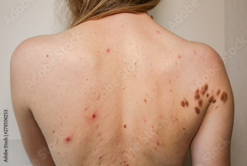 Big birthmarks and freckles on the girl's skin. Medical health photo of back. Woman's oily skin with problems acne.
