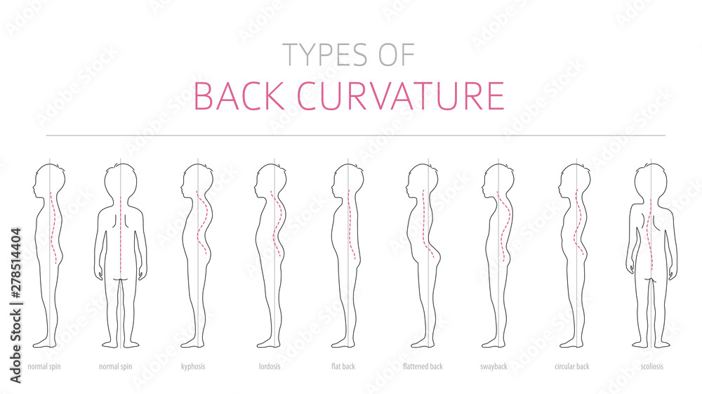 Types of kid`s back curvature. Medical disease infographic. Outline