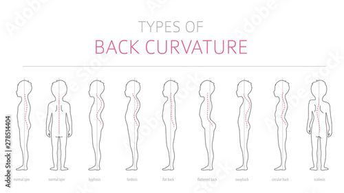 Types of kid`s back curvature. Medical disease infographic. Outline version