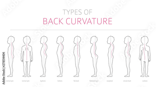 Types of kid`s back curvature. Medical disease infographic. Outline version