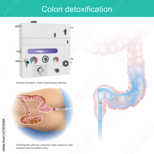 Colon detoxification. Sample illustration flushing the colon by using the water pressure pipe inserted into the patient anus.