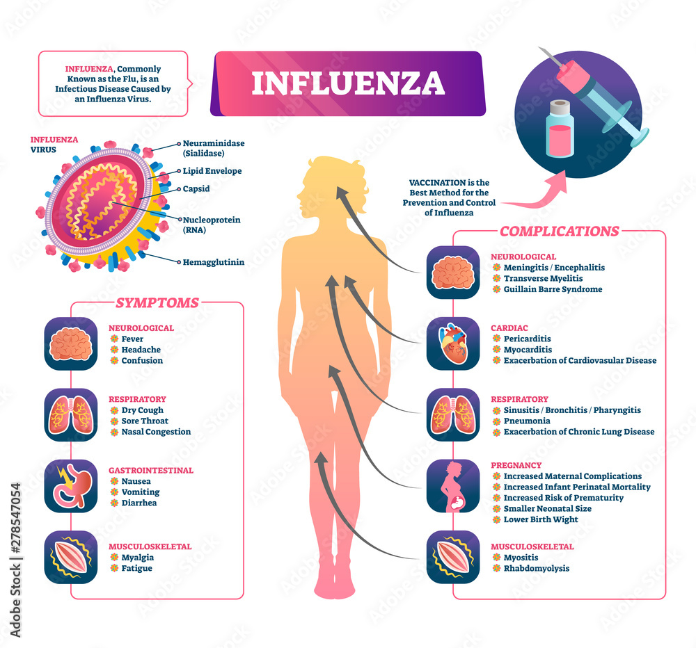 Influenza vector illustration. Labeled flu symptoms and complication ...