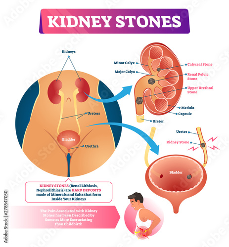 Kidney stones vector illustration. Labeled internal hard deposits disease.