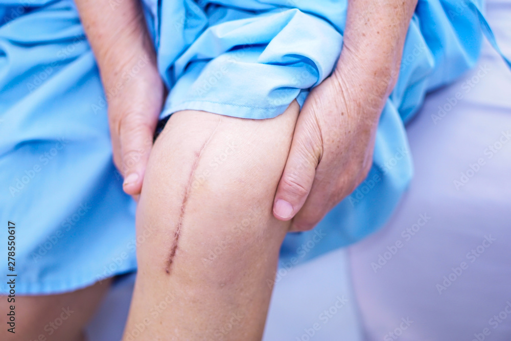 Fototapeta premium Asian senior or elderly old lady woman patient show her scars surgical total knee joint replacement Suture wound surgery arthroplasty on bed in nursing hospital ward, healthy strong medical concept.