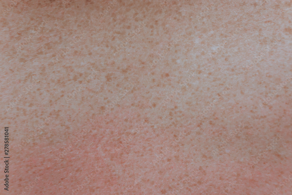 Fototapeta premium freckles on the back close up
