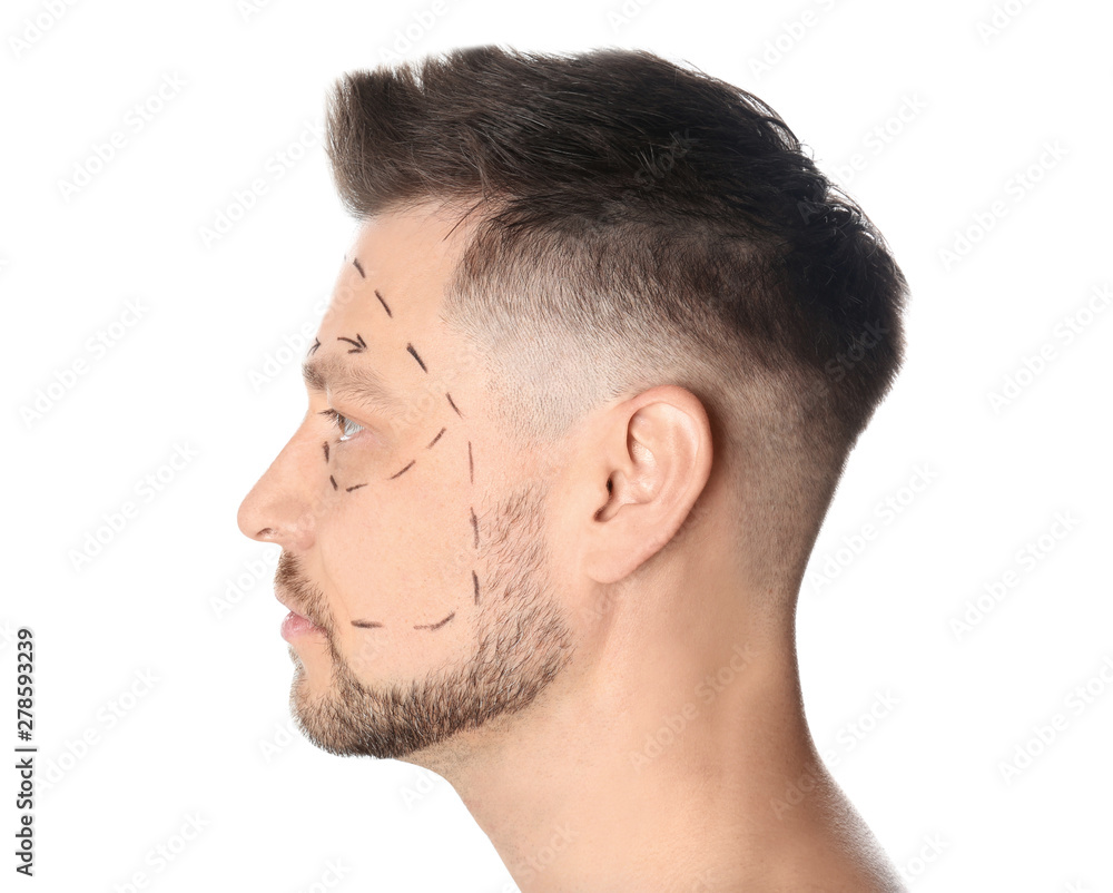 Man with marks on face for cosmetic surgery operation against white background Man with marks on face for cosmetic surgery operation against white background